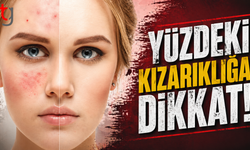 Yüzdeki kızarıklığa dikkat!