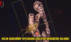MIT Araştırmacılarından Kolon Kanserinde Dikkat Çeken Keşif