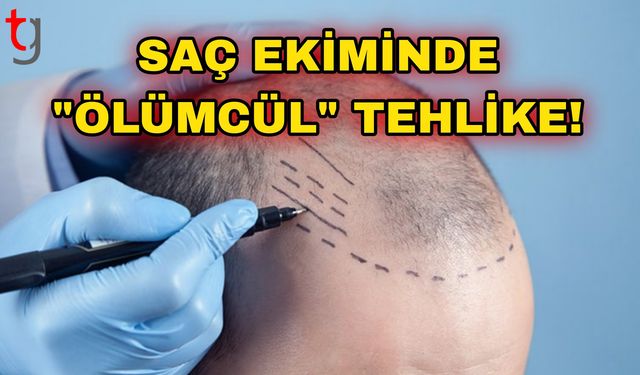 Saç Ekiminde "Ölümcül" Tehlike!