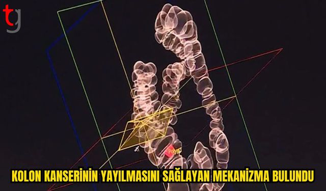 MIT Araştırmacılarından Kolon Kanserinde Dikkat Çeken Keşif