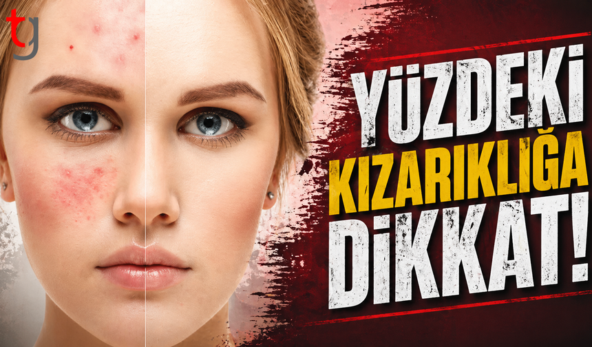 Yüzdeki kızarıklığa dikkat!